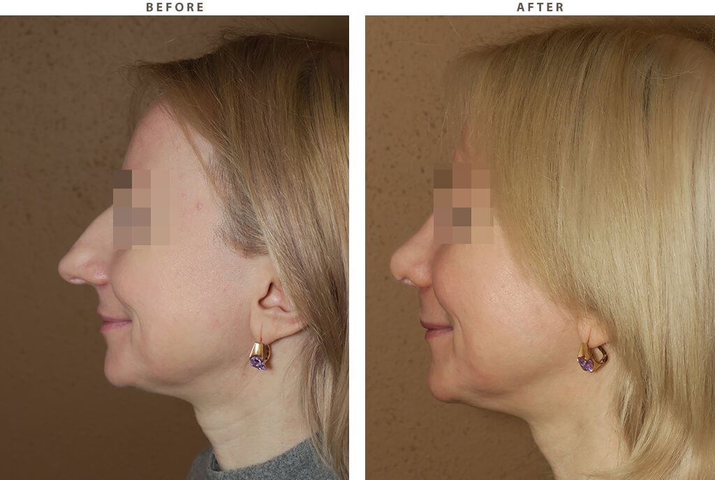 Rhinoplasty - Before and After Pictures