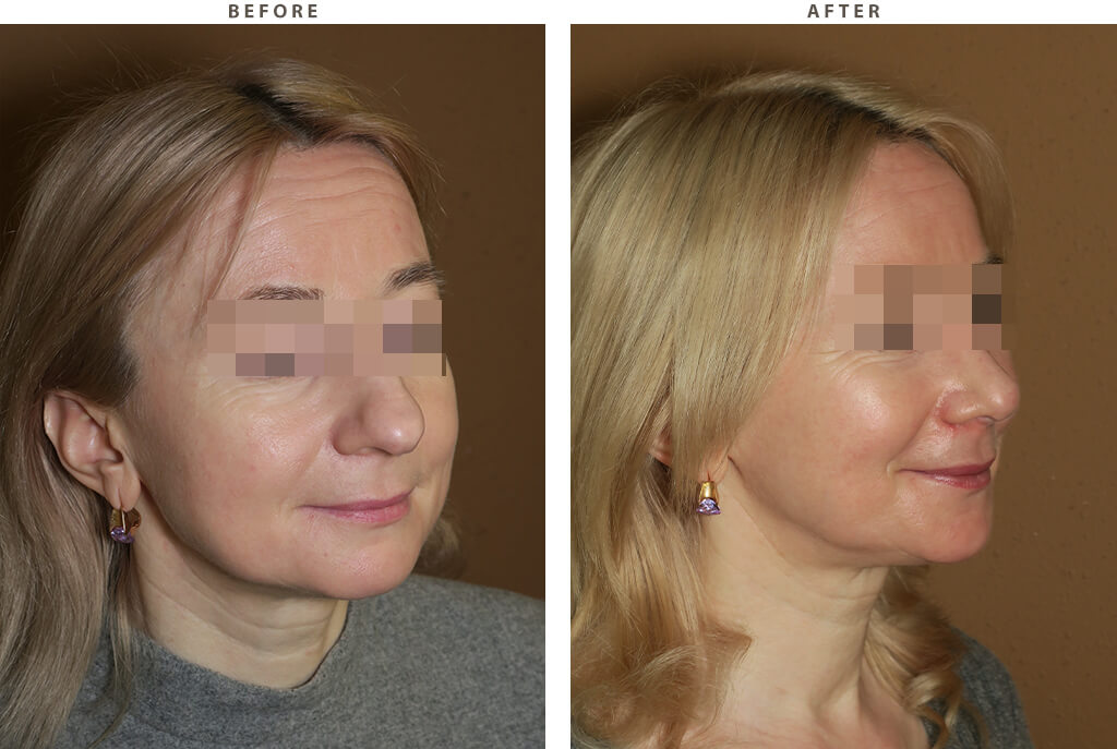 Rhinoplasty - Before and After Pictures