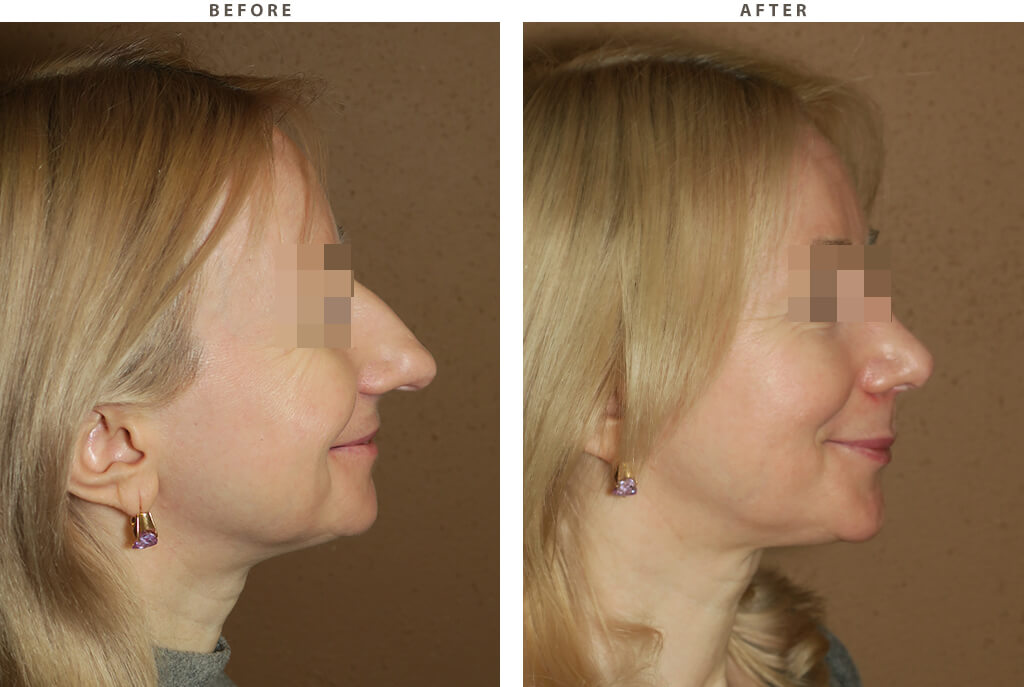 Rhinoplasty - Before and After Pictures