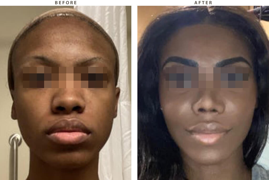 Rhinoplasty - Before and After Pictures