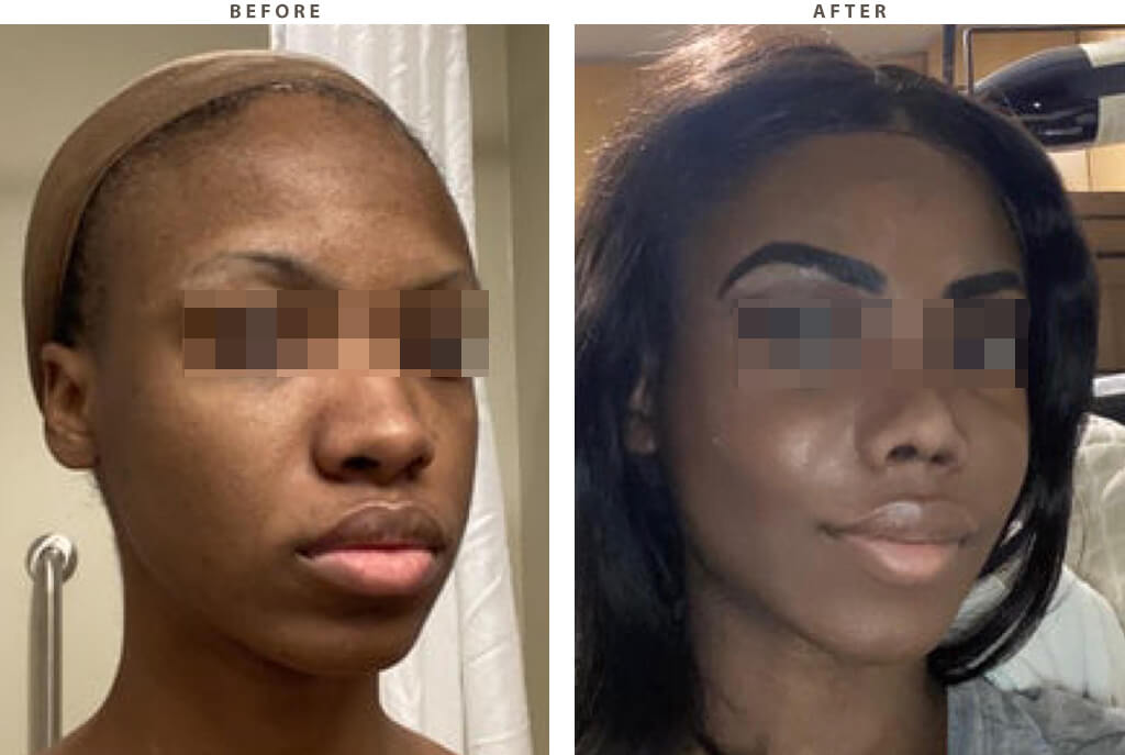 Rhinoplasty - Before and After Pictures