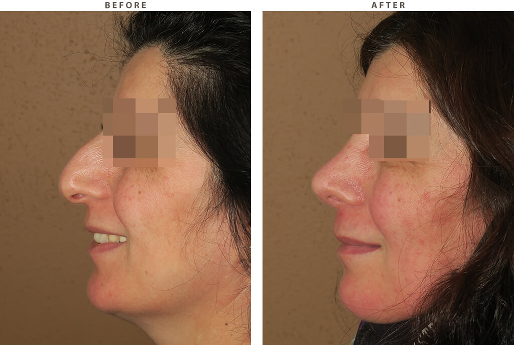 Rhinoplasty - Before and After Pictures