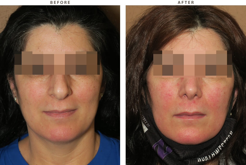 Rhinoplasty - Before and After Pictures