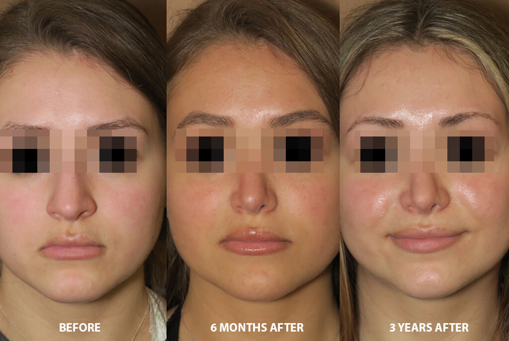 Rhinoplasty - Before and After Pictures