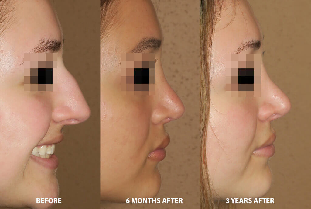 Rhinoplasty - Before and After Pictures