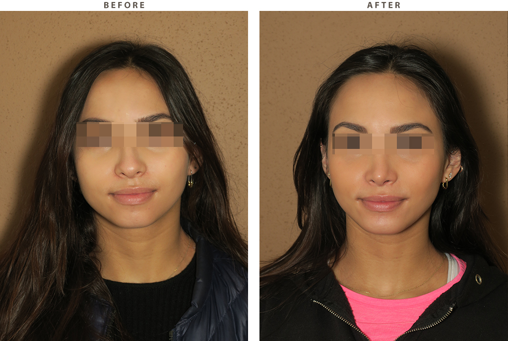 Rhinoplasty - Before and After Pictures