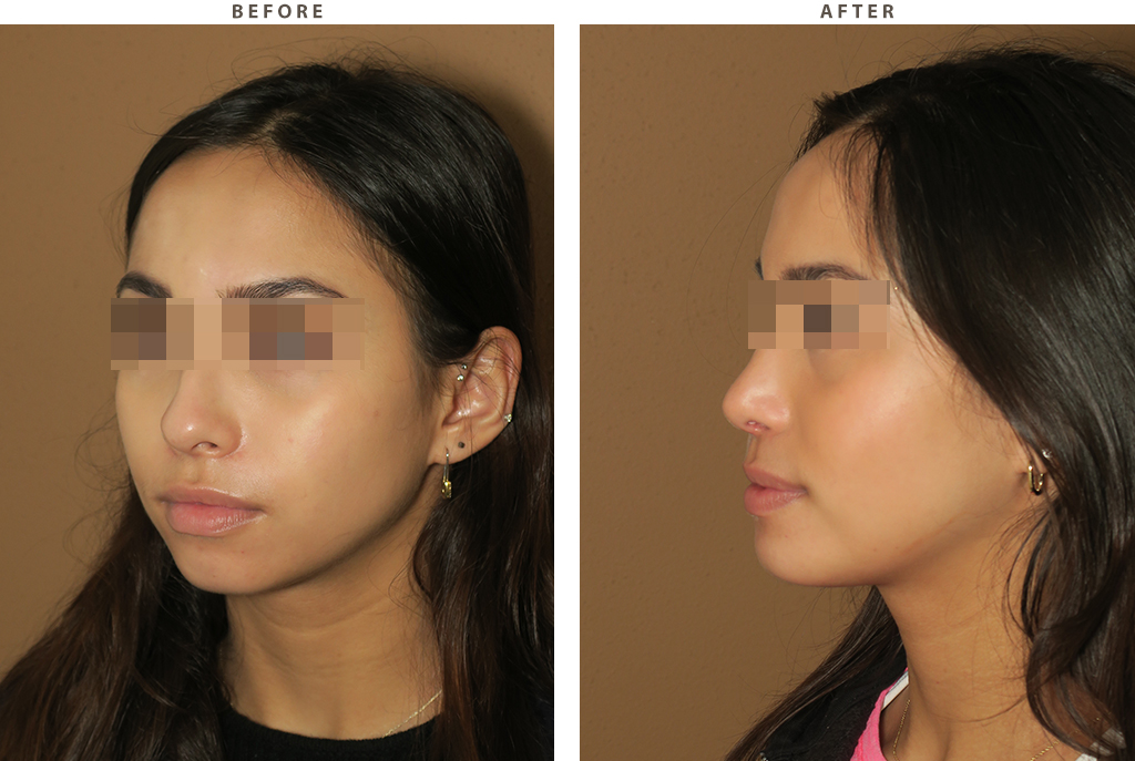 Rhinoplasty - Before and After Pictures