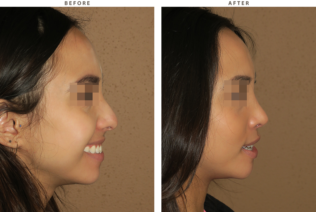 Rhinoplasty - Before and After Pictures