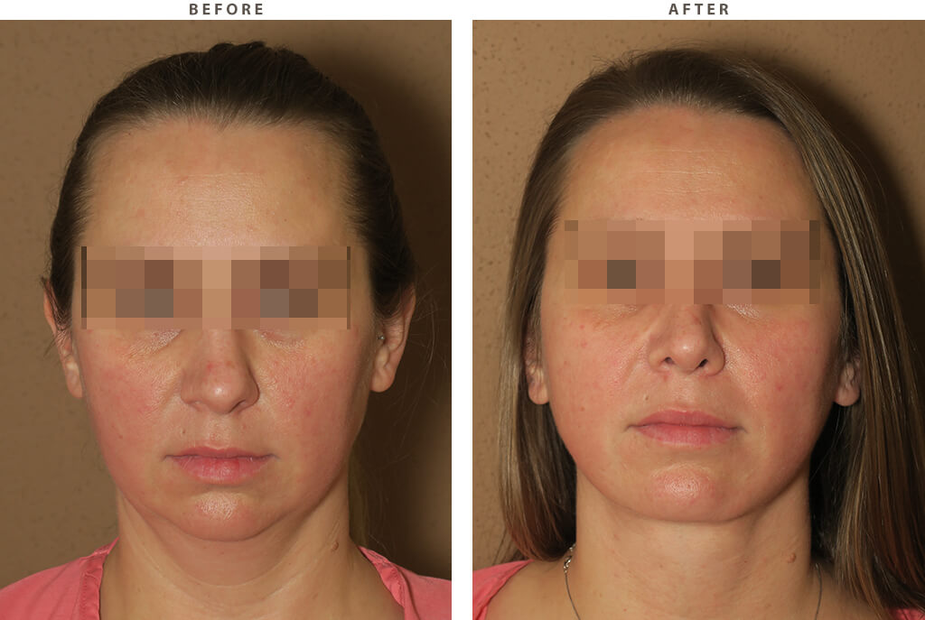 Rhinoplasty - Before and After Pictures