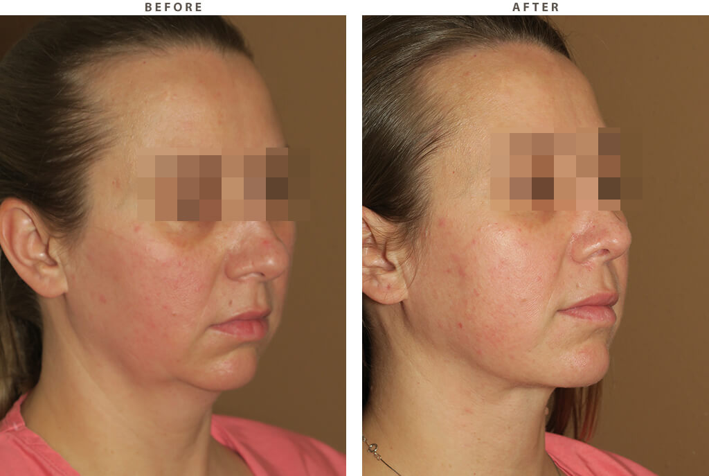 Rhinoplasty - Before and After Pictures