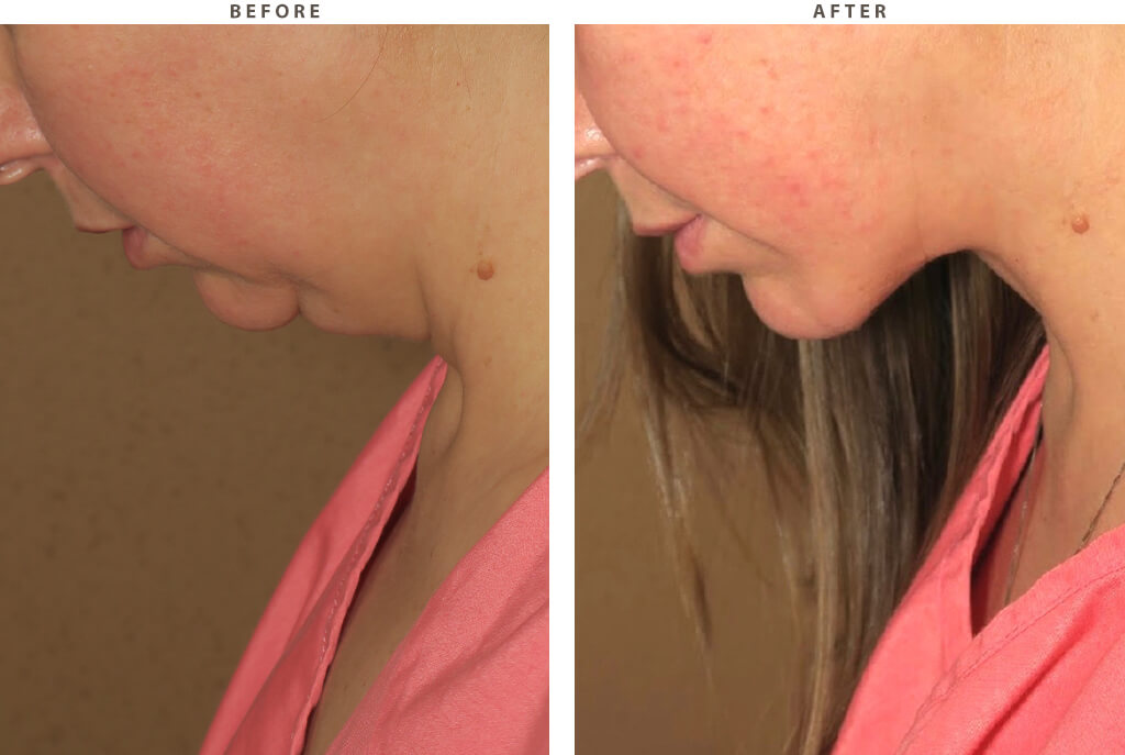 Rhinoplasty - Before and After Pictures