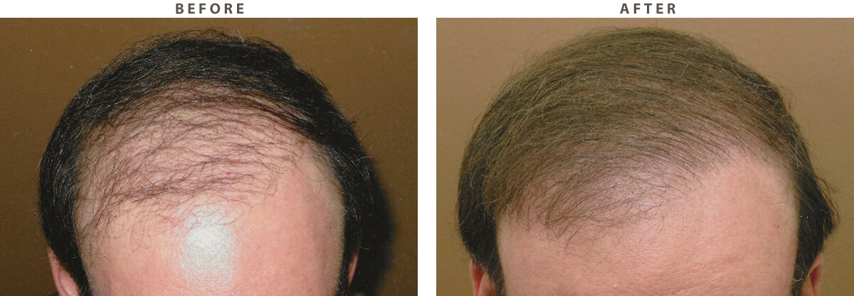 Body Hair Transplant - Before and After Pictures